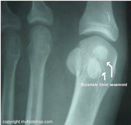 Sesamoid Fractures | Causes and treatment options | MyFootShop.com