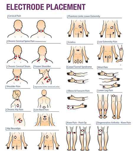 Tens Unit Placement Diagram