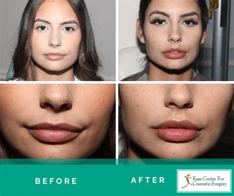 Lip Plastic Surgery - Before & Afters - Kass Center for Cosmetic Surgery