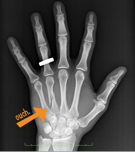 broken-hand - Tanya Coats Occupational Therapy