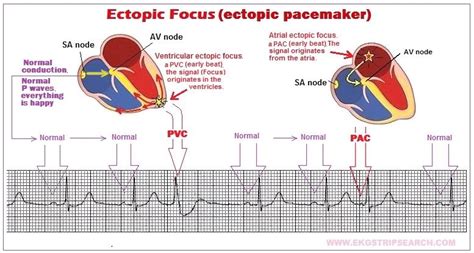 What is a ventricular escape beat?