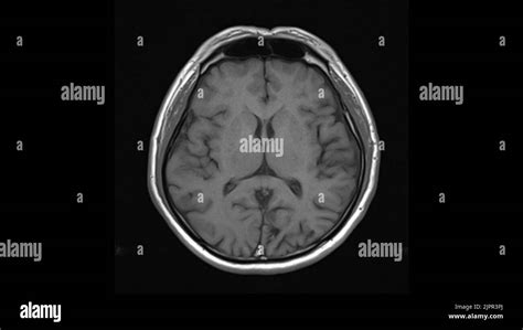 Healthy brain, MRI scan Stock Photo - Alamy