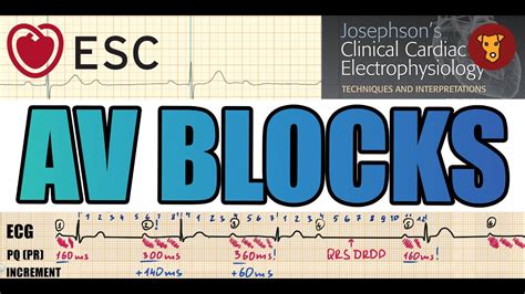 AV BLOCK, ECG criteria, HIS bundle electrogram site of origin, managment, Lyme carditis ...