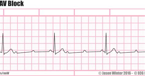 ECG Educator Blog : 3rd Degree AV Block