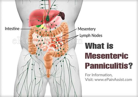 Mesenteric Panniculitis