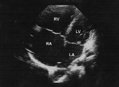 Large secundum ASD with right-sided enlargement Sonography Student, Work Grind, Heart Function ...