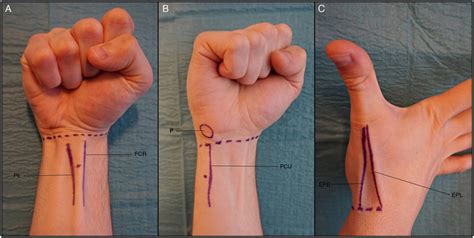 EM Didactic: Wrist Block (Landmark Technique)