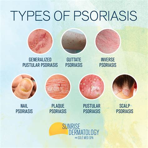 Psoriasis Symptoms, Types, And Images, 48% OFF