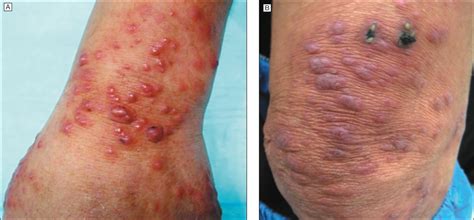 Papules, Plaques, and Nodules in an Immunocompromised Patient ...