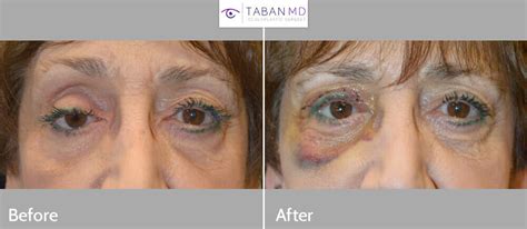 Prosthetic Eye & Socket Surgery Before and After Photos | Taban MD