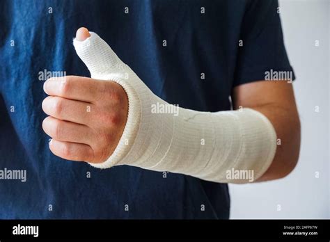 Man with plaster cast on broken hand, broken thumb,broken wrist Stock Photo - Alamy