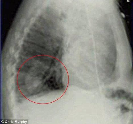 Man Had Fir Tree Growing In His Lung