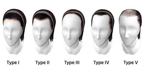 The Different Types of Hairlines - Human Hair Exim