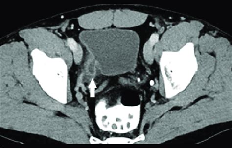 CT scan (axial image) with intravenous contrast Omnipaque 350 (80 mL ...