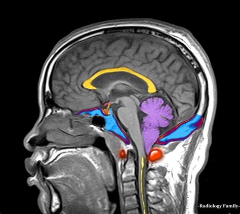 Cerebellar Tonsils Mri