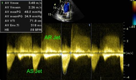 Aortic stenosis gradient – All About Cardiovascular System and Disorders