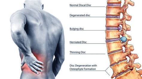 Degenerative Disc Disease - Symptoms & Causes