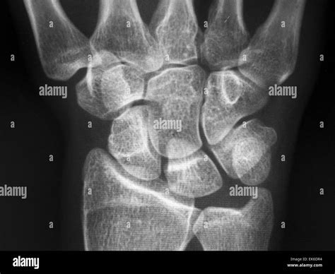 X-Ray Of Carpal And Metacarpal Bones In The Human Hand Stock Photo - Alamy