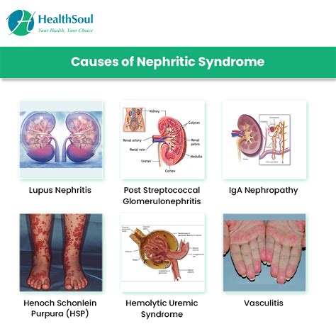 Nephritic Syndrome: Symptoms and Treatment – Healthsoul