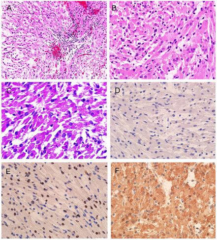 Sheets of granular cell tumor with lymphocytic aggregation (A ...