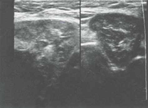 A: Ultrasound image showing bilateral enlarged submandibular lymph ...