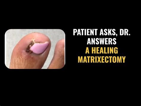 Patient Asks, Dr. Answers - Matrixectomy & Proper Healing Edition - YouTube