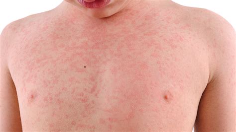 How to get rid of heat rash and prickly heat in children and adults - signs, symptoms and ...