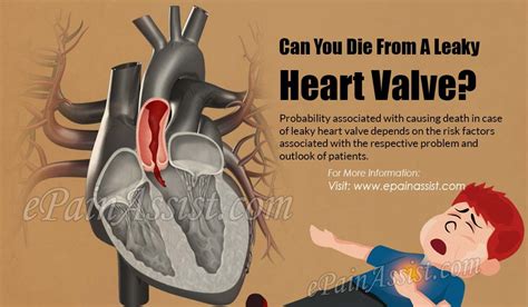 How To Fix A Leaky Heart Valve - The heart valves will cause extreme shortness of breath if they ...