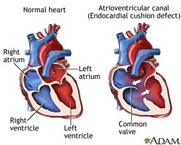 Atrioventricular Septal Defect (AVSD) - Cardiothoracic Surgery