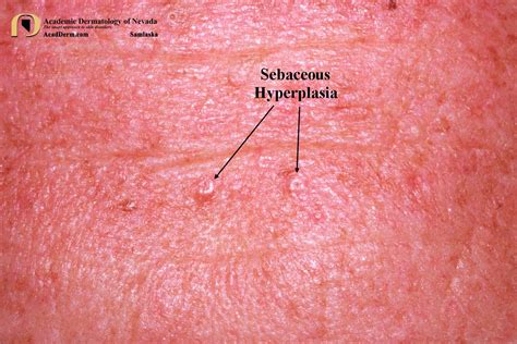 Sebaceous Gland Hyperplasia On Lips | Lipstutorial.org