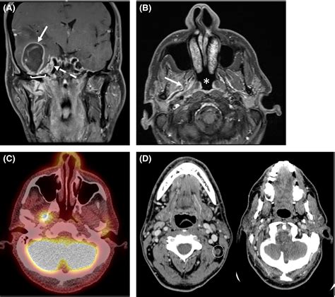 Nasopharyngeal Cancer