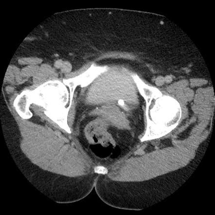 Ureterocele | Radiology Reference Article | Radiopaedia.org