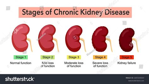 Stages Chronic Kidney Disease Infographic Concept Stock Vector (Royalty Free) 2257235557 ...