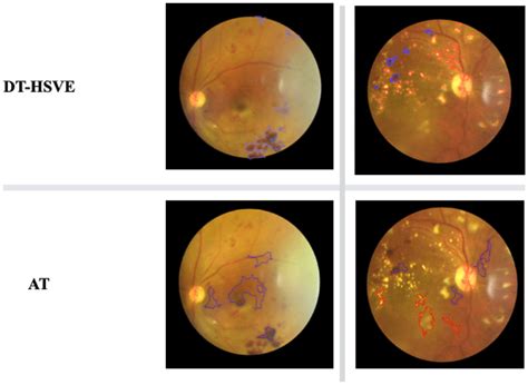 Exudate and hemorrhage segmentation | Download Scientific Diagram