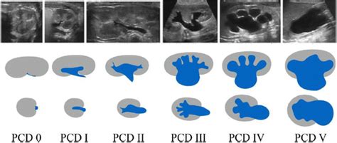 Hydronephrosis Grading Ultrasound