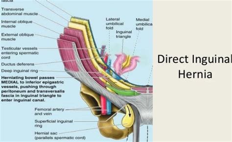 Laparoscopic Bilateral Inguinal Hernia Surgery Tep – Otosection