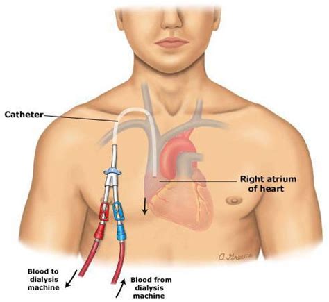 Central Venous Catheter Market Size, Trends, Shares, Insights, Forecast - Coherent Market ...