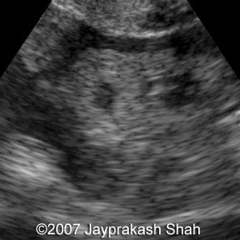 📃 Extrauterine pregnancy, right uterine tube