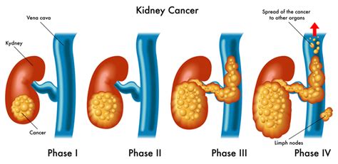 Kidney Cancer Symptoms Usually Occur Later Rather Than Sooner - University Health News