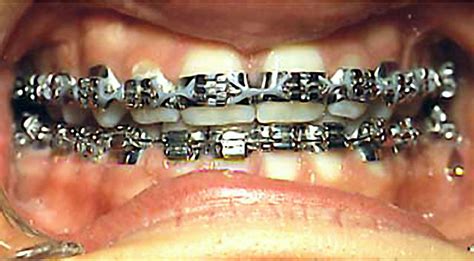 Old school braces 1970s | Orthodontics braces, Metal braces, Spacers for braces