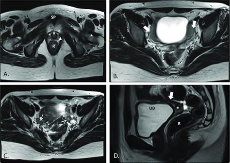 MRI of pelvis T2-weighted TSE images: Axial (A; at the level of... | Download Scientific Diagram