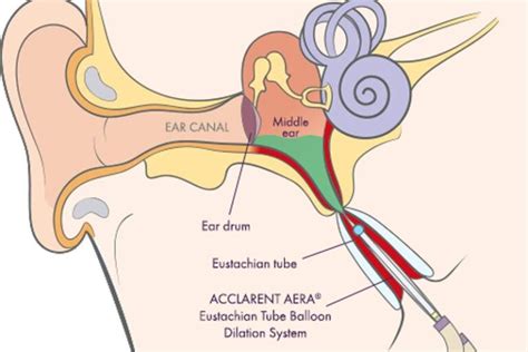 Advanced ENT Treatments | Balloon Sinuplasty | Baha Ear Implant