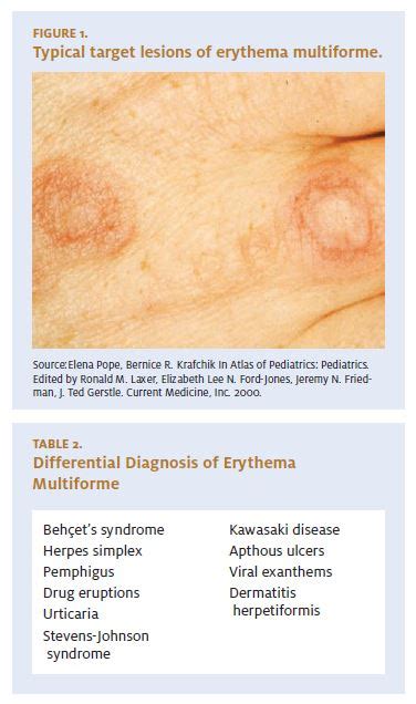 Management of Erythema Multiforme in the Urgent Care Setting - Journal of Urgent Care Medicine