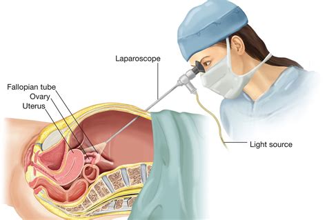 Laparoscopic Endometriosis in Nigeria - Laparoscopy Surgery