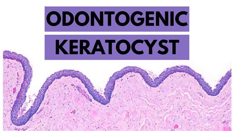 Edropin - Odontogenic Keratocyst -Clinical features, Radiology, Histology and Treatment.