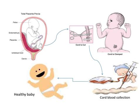 Umbilical cord stem cell