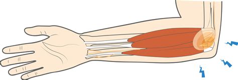 Ulnar Nerve Entrapment at the Elbow (Cubital Tunnel Syndrome, ulnar nerve entrapment - mi-pro.co.uk