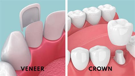 Veneers vs. Crowns: What's the Difference & Which is Better