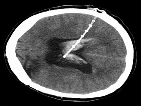 Ventriculoperitoneal shunt: Types, procedure, risks, and recovery