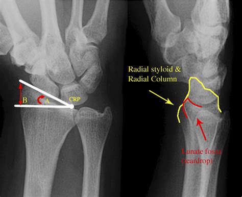 Figure 6 from Radial styloid fractures. | Semantic Scholar